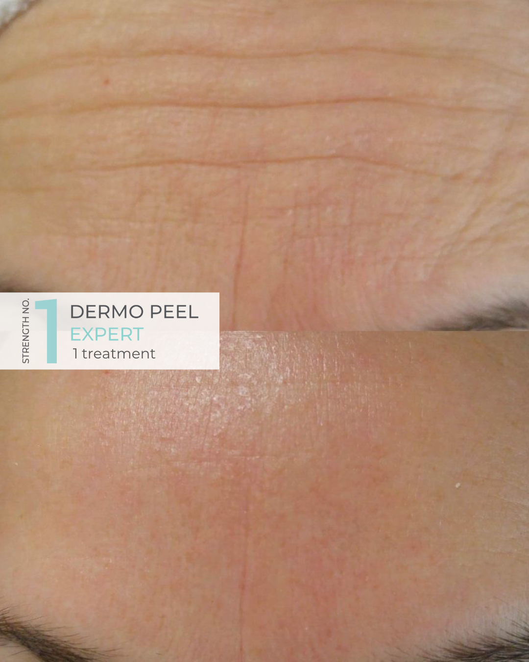 Dermo Peel Expert Strength 1 Before and After Results